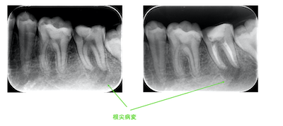 歯髄失活と根尖病変をレントゲン確認