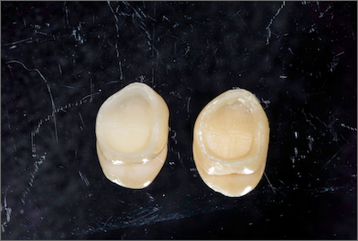 仮歯と本番を比較