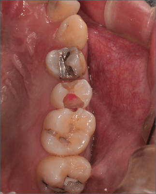 隔壁を作製するために、歯髄腔付近のカリエスを除去
