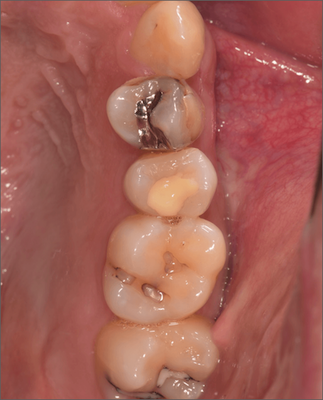 根管内にアクセスし、感染歯髄の除去