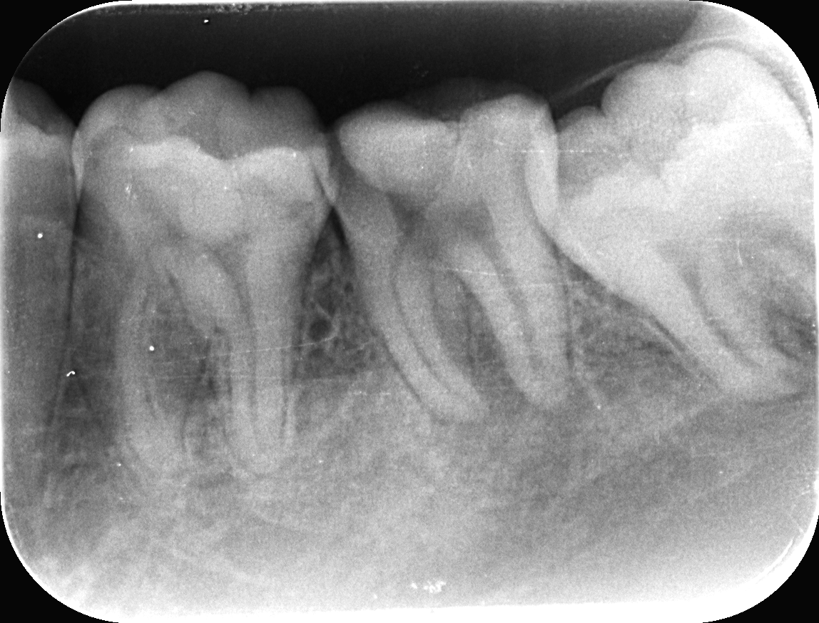 抜歯になる歯って 浜松市中区の歯医者 歯科 松山デンタルオフィス