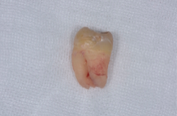 歯冠がすべて出ているときは、分割することなく抜歯することができます